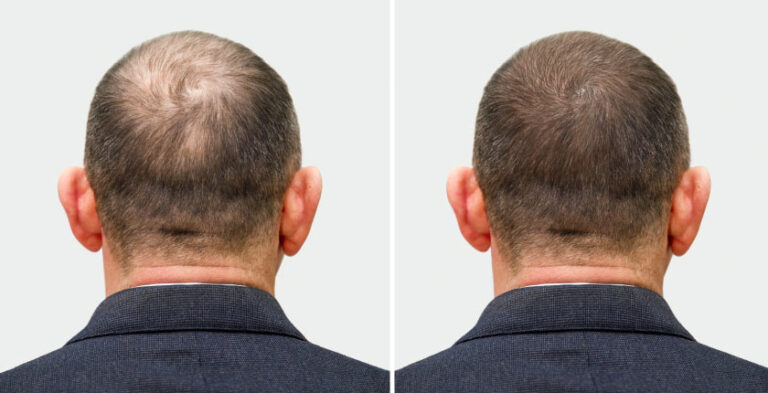 PRP Hair Treatment