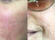 Microneedling Before & After
