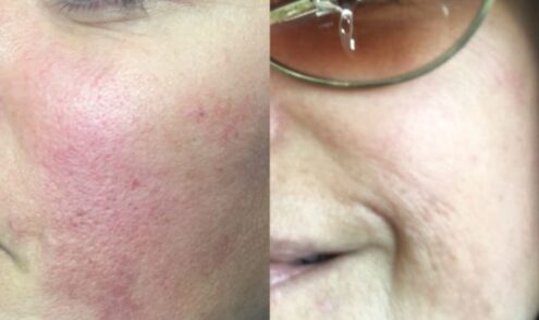 Microneedling Before & After