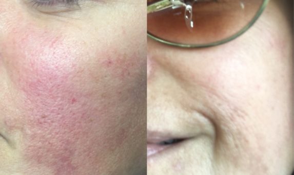 Microneedling Before & After Microneedling Before & After