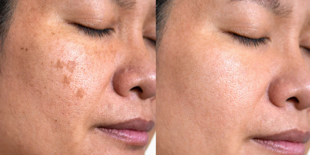 PRP Microneedling PRP Microneedling