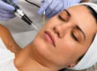 PRP Microneedling in NYC