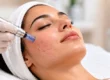 Microneedling for acne scars